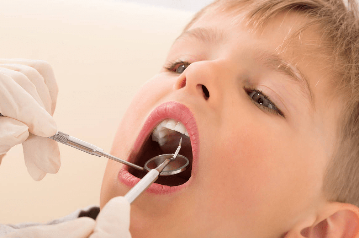 预防儿童龋齿牙齿涂氟不能小看想让小孩有一口好牙就得注意了