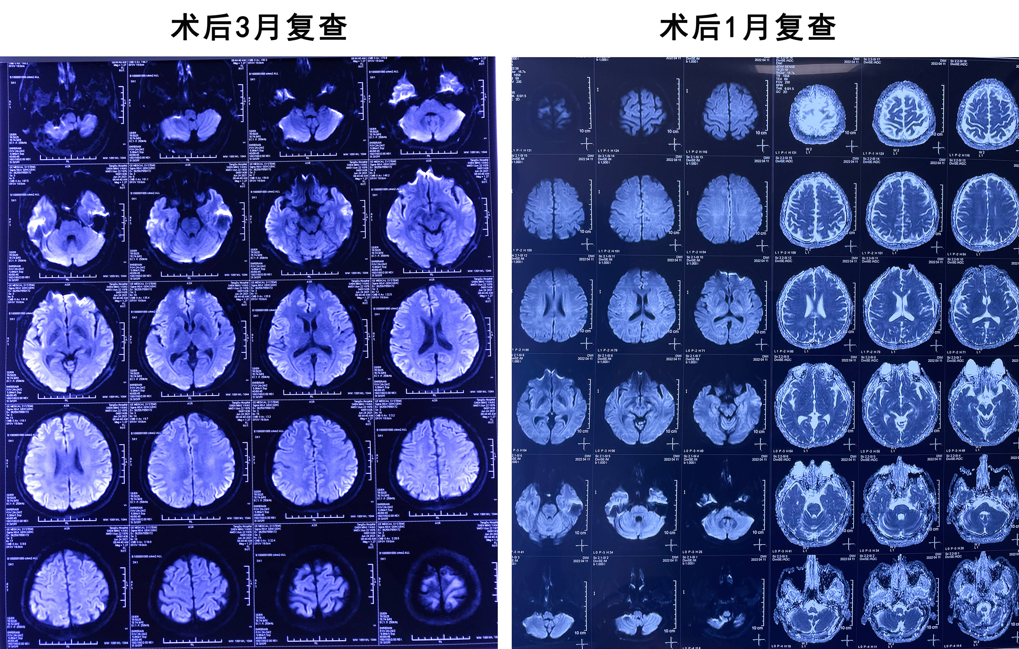 脑干囊肿图片