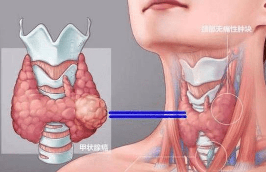 北京甲状腺专家赵萍提醒：身体频繁出现3现象，警惕甲状腺癌