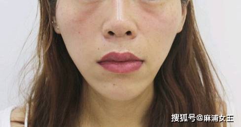 印第安纹剥离后多久能看到效果看完这篇告别印第安纹烦恼