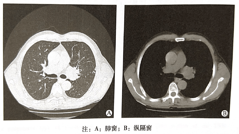 肺大细胞癌图片