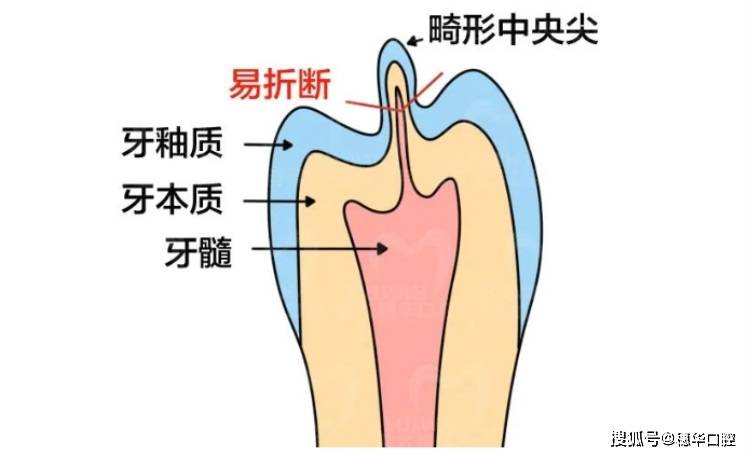 孩子恆牙萌出時,中間冒出一個白色