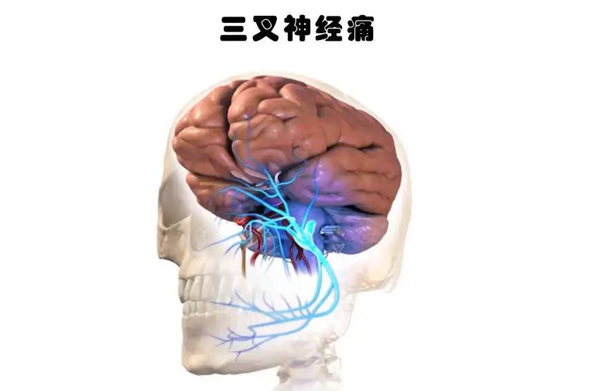 重庆黄泥磅医院专家解析:三叉神经痛复发原因_痉挛_触发_都想