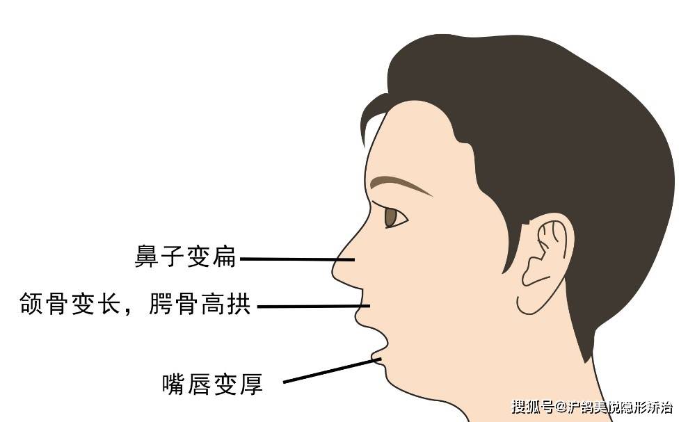 造成的咬合异常;后牙锁颌影响咀嚼功能;严重下颌前突则造成吞咽异常