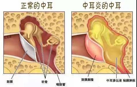 中耳炎是怎么引起的图片