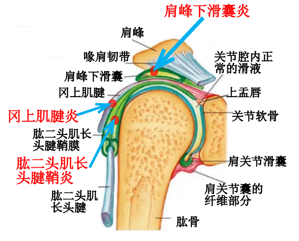 肩周炎的诊治,看这篇就够了!伯科疼痛舒缓液_活动_患者_关节