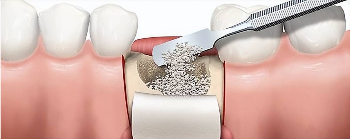 种植牙骨粉是什么?