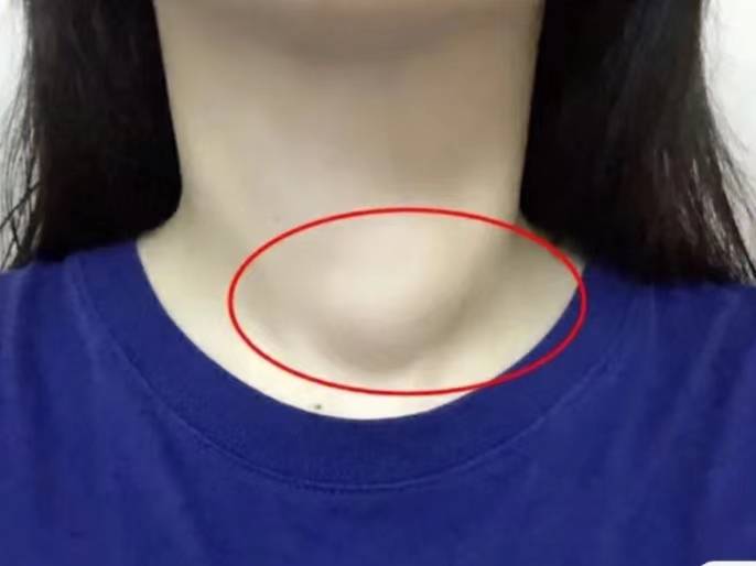 甲状腺结节康复者历时2个月总结的"散结"妙招,学会了终身受益!