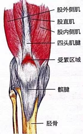 广州体适能培训:股四头肌肌腱炎