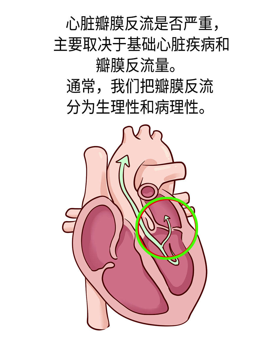 体检发现的心脏瓣膜反流是什么?要紧吗?