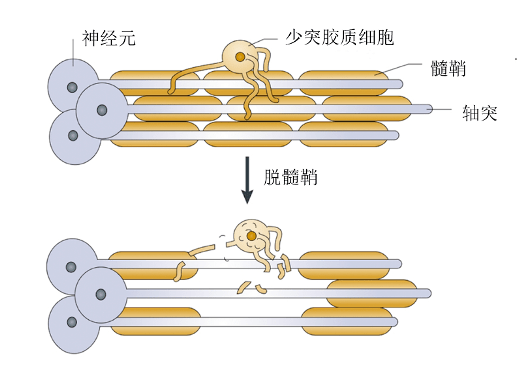 如果报告中出现了脱髓鞘