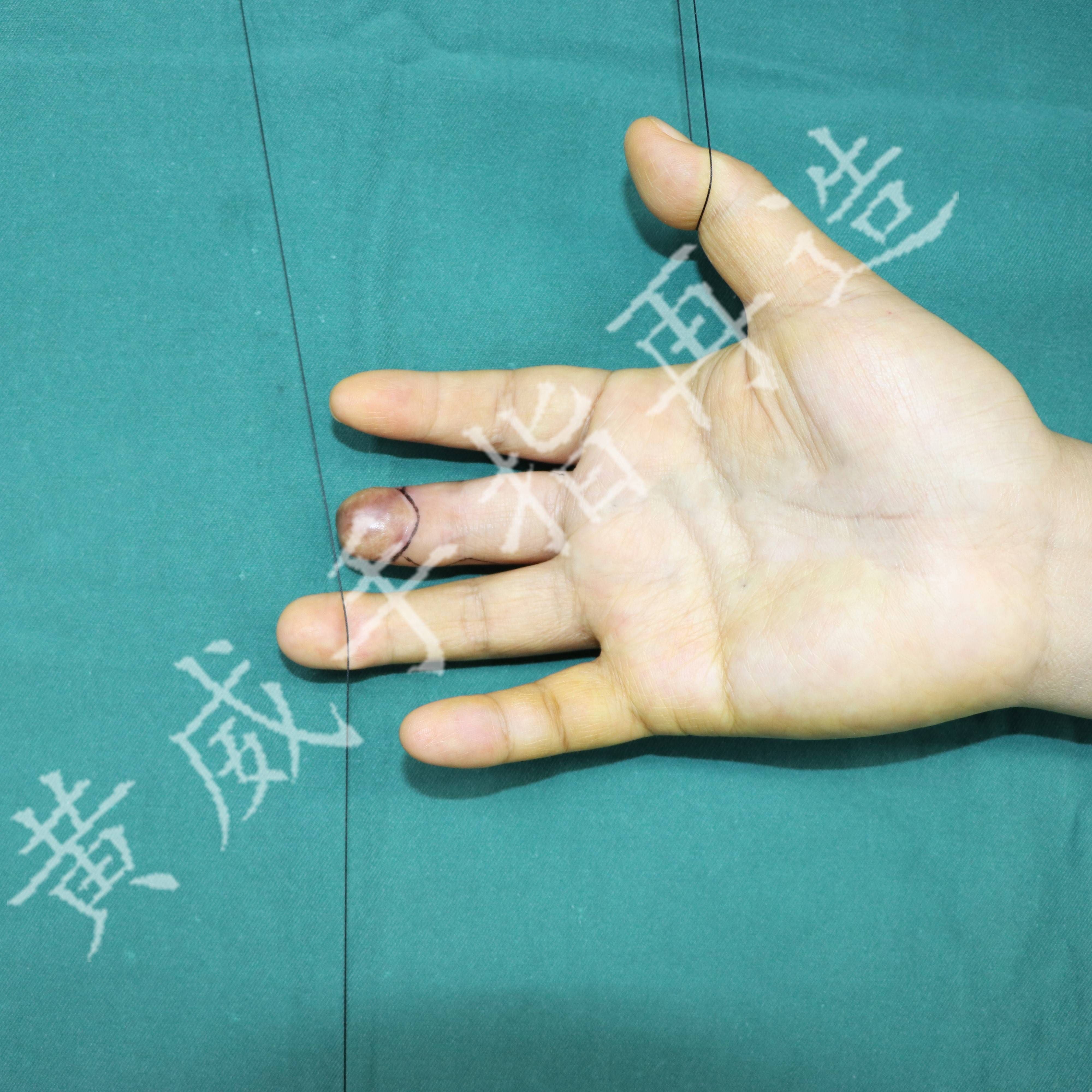 【手指再造专家黄威案例分享】母亲手指残缺,女儿存钱为其修复