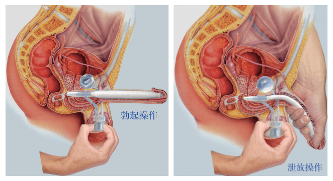 男性植入假体手术图片
