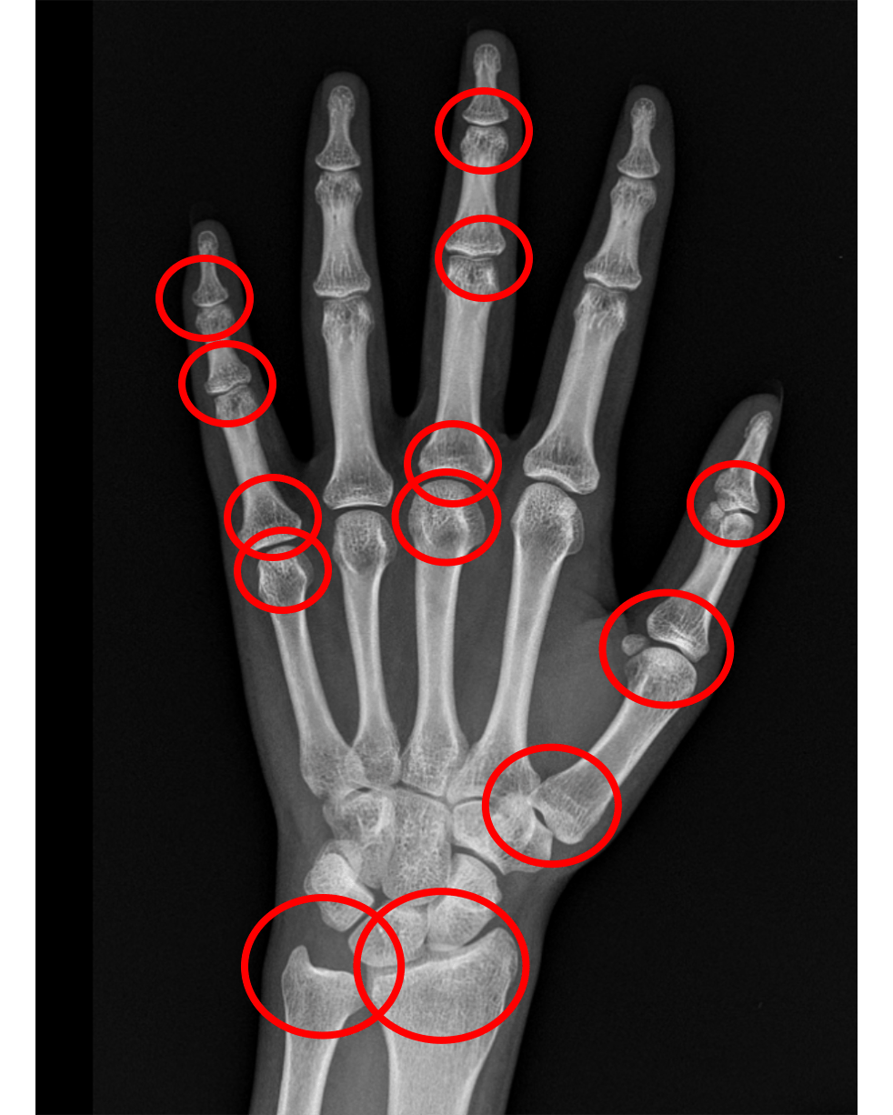但是想要知道孩子还能长多高的话,还需要通过中华05判断骨龄来知道