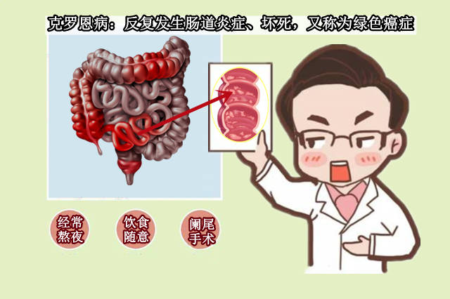 小常宝健康科普:克罗恩病是怎么引起的?_肠道_疾病_病因