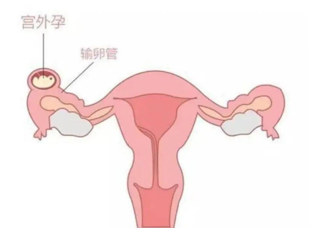 宫外孕b超检查报告单图片