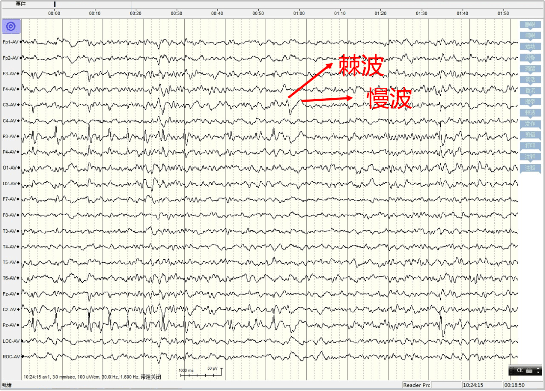 异常脑电图尖波尖慢波图片
