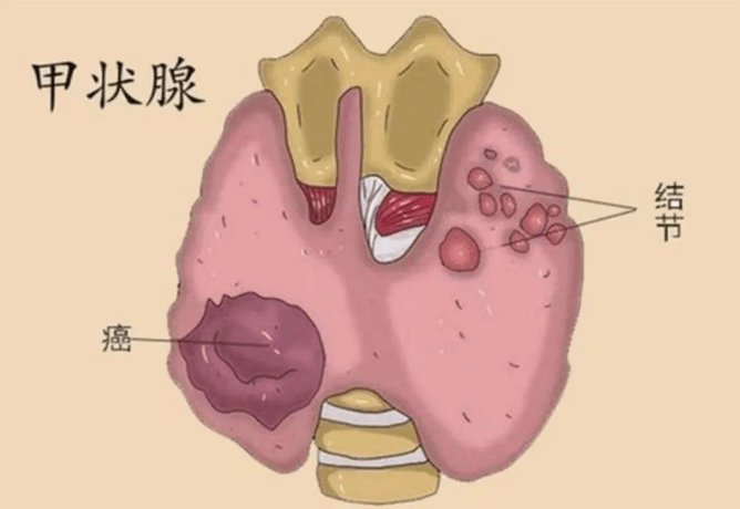 北京中西医结合甲状腺专家合作诊疗中心为您讲解：甲状腺结节3类是什么意思？（北京 甲状腺结节 中医）