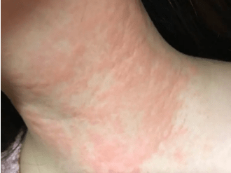 脖子上戴项链后瘙痒难耐?这种情况可能是"接触性皮炎"!