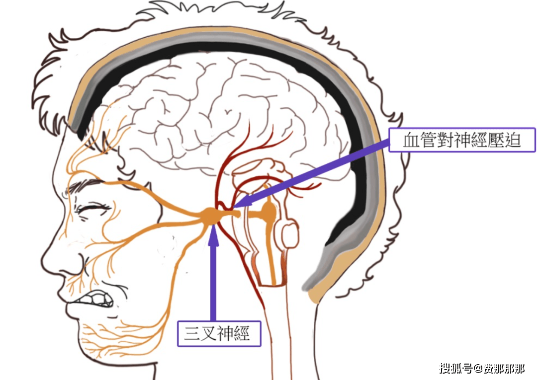 三叉神经简笔画图片