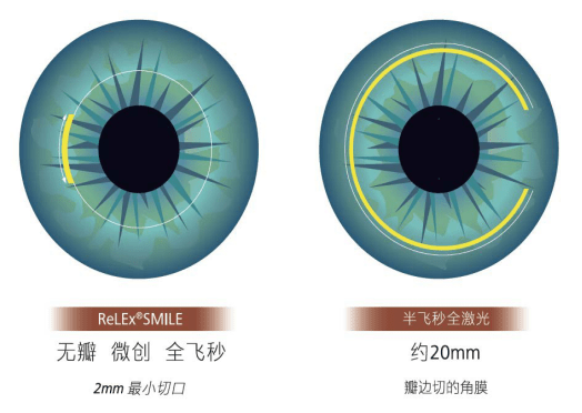 近视手术大概多少费用 半飞秒还是全飞秒？徐州近视手术攻略-第3张图片-索考网