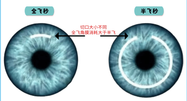 近视手术大概多少费用 半飞秒还是全飞秒？徐州近视手术攻略-第2张图片-索考网