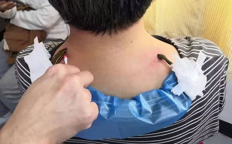 易经八卦,河图,洛书为理论依据,采用针刺脐部(神阙穴)来达到平衡阴阳