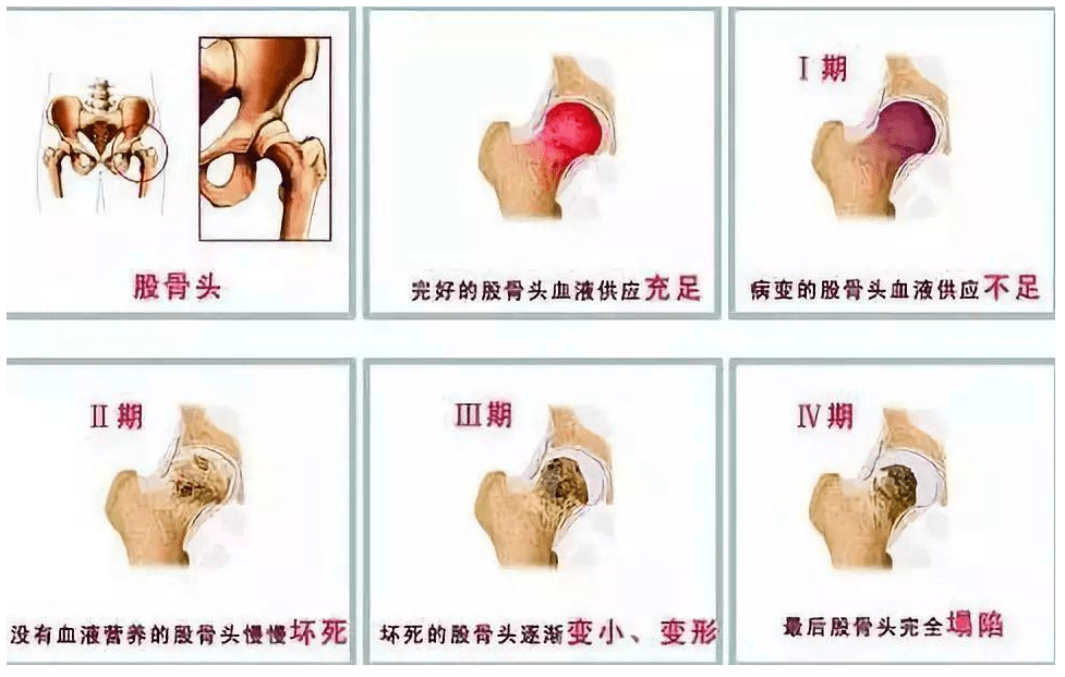 股骨头的三个血供来源图片