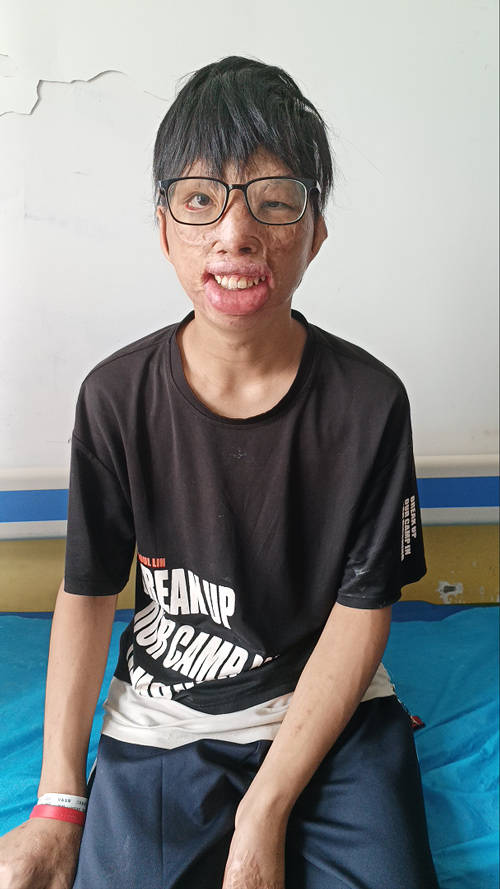 眼皮缺失,下唇外翻.大火让他面目全非,郑州仁济医院守护烧伤少年的梦