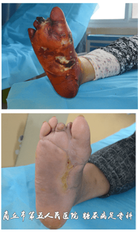 老人得了糖尿病足怎么治才能好的快?_控制_治疗_创面