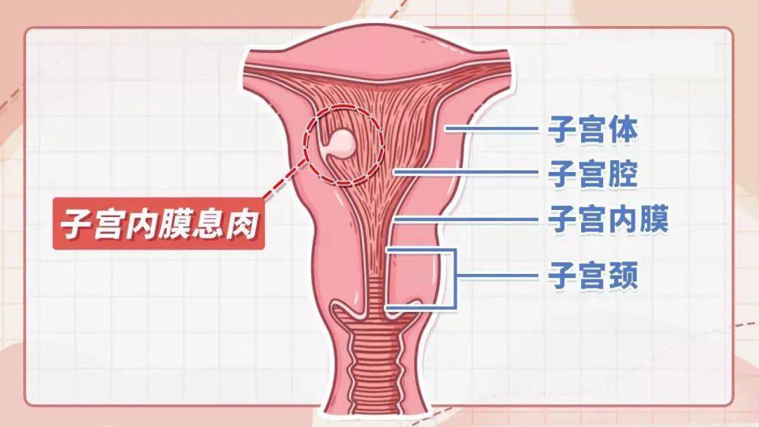 子宫内膜息肉有什么症状(子宫内膜有息肉是什么原因引起的)