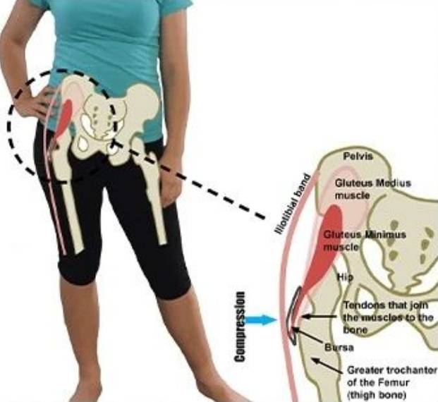 小心五種疼痛預示股骨大轉子滑囊炎_臀部_磨擦_髖關節