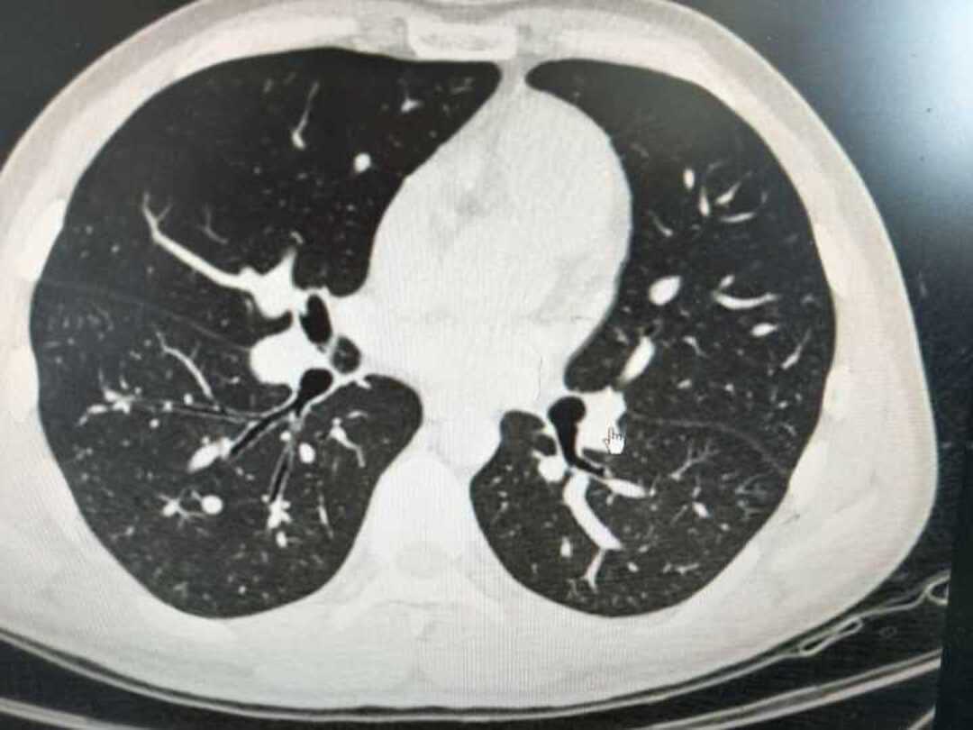 吴海霞主任科普:磨玻璃结节_www_肺部_体检