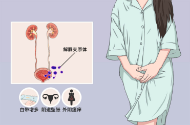 女性感染妇科支原体,会出现外阴瘙痒,白带增多,阴道坠胀等症状,其阴道