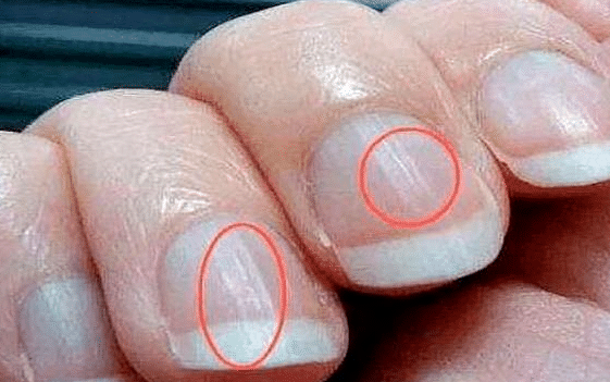 体内有癌,手指先知!再次提醒:手部若有1种异常,或是肝癌前兆