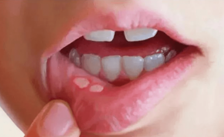 牙龈长白斑是什么情况图片