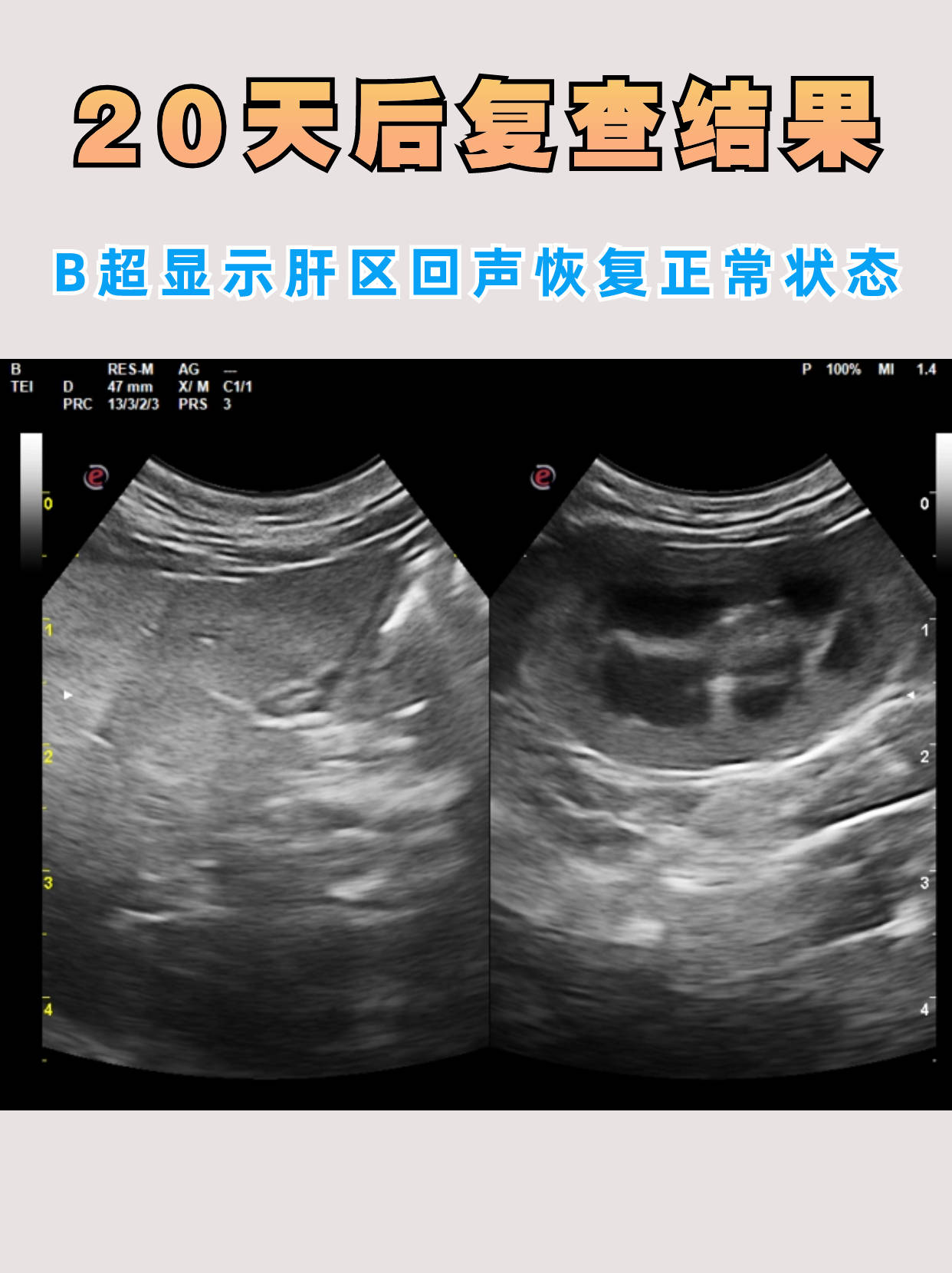 使用龙昌胆汁酸20天中