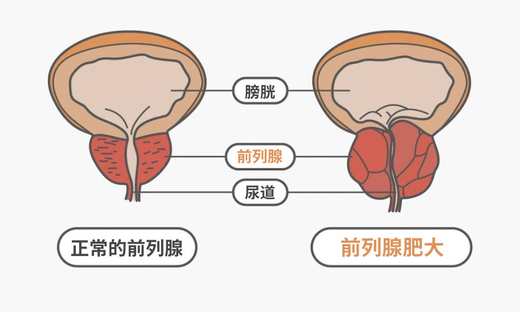 前列腺稍大 来自搜狐网