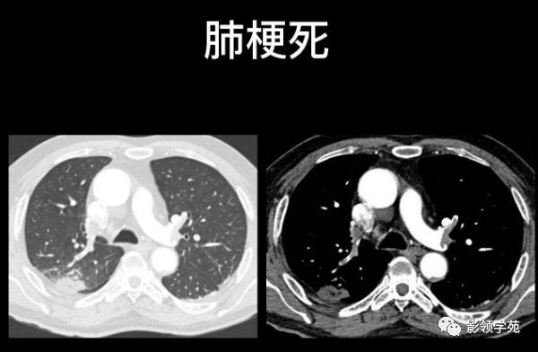 肺栓塞的影像诊断与鉴别诊断