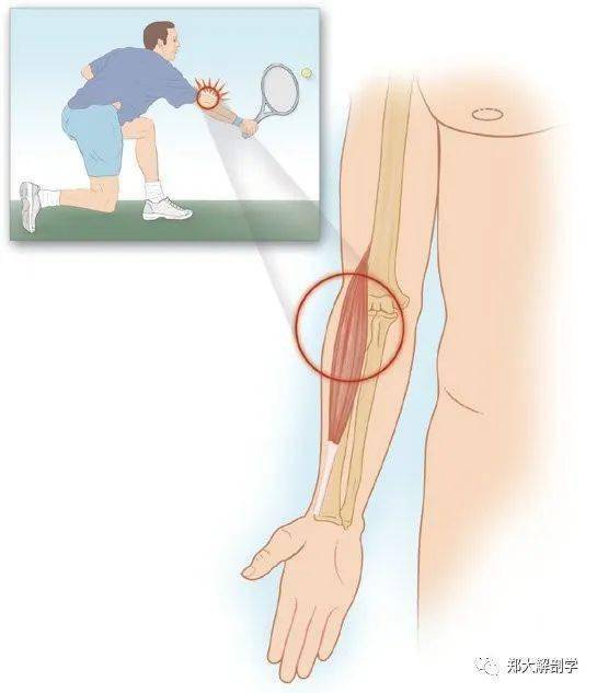 肱桡肌疼痛是什么原因图片