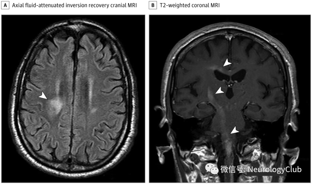 flair高信號病灶;b:t2wi可見沿右側錐體通路的高信號;在脊髓延髓水平