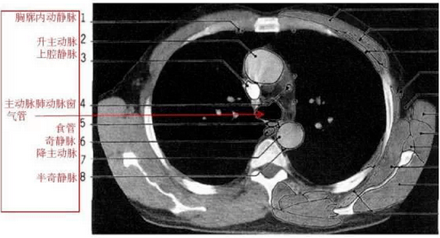 详尽的胸部ct影像示意图
