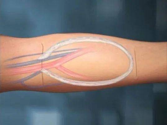 老人血液透析4年左侧血管耗竭人工血管内瘘术重建生命线