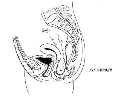 自己画的)1诊断盆底腹膜疝环口一般很大,临床上很少会引起肠梗阻症状
