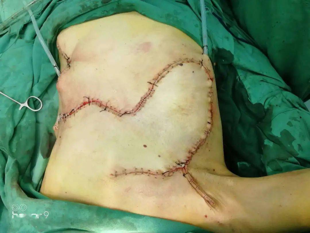 乳房全切手术过程图片图片