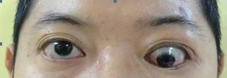 暴露性角膜炎:眼球突出和眼睑退缩,滞后,可引起睑裂闭合困难,导致暴露