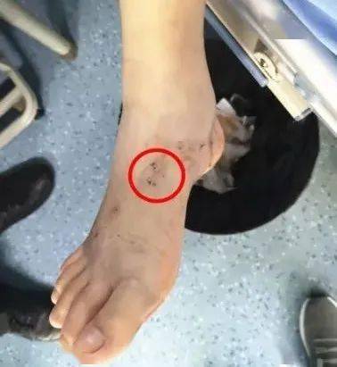 宜宾女子被蜘蛛咬伤没当回事没想到