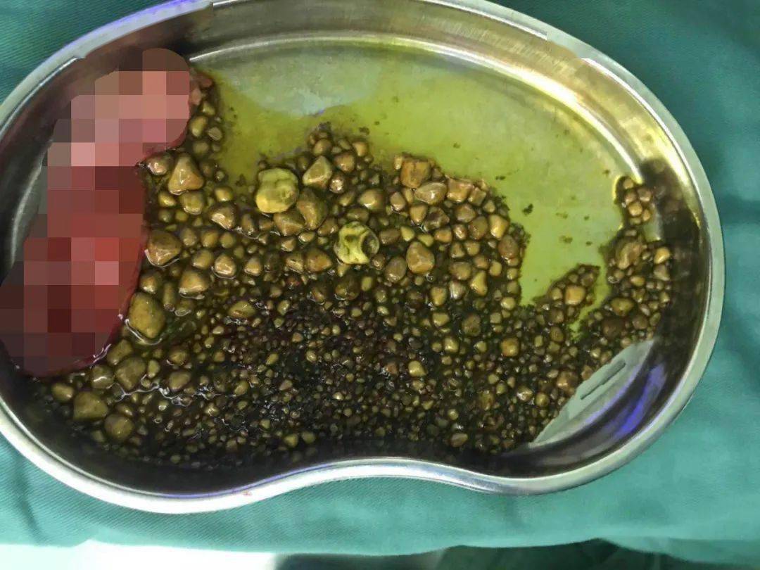 微创取石,让石头不再"疯狂"家住柘城县的吴女士(化名)患有胆结石多