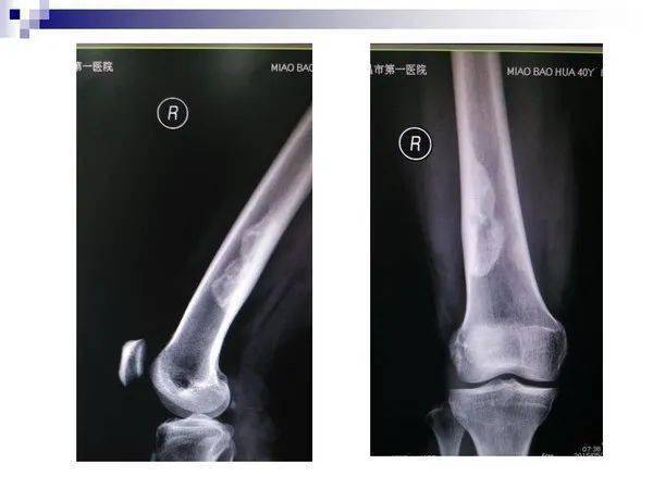 股骨非骨化性纤维瘤图片