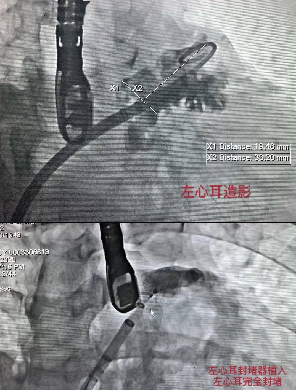 左心耳血栓图片